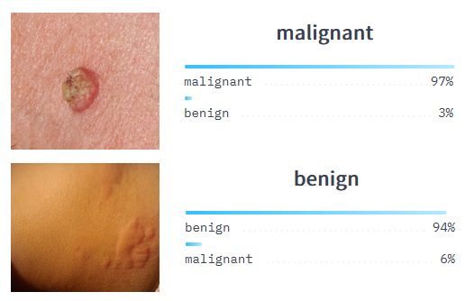 Skin cancer classification model example