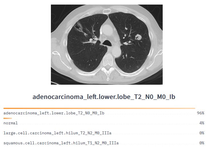Lung cancer classification model to analyze CT medical imaging