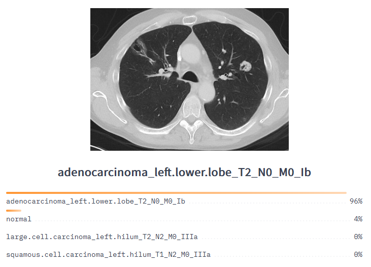 Lung cancer <yoastmark class=