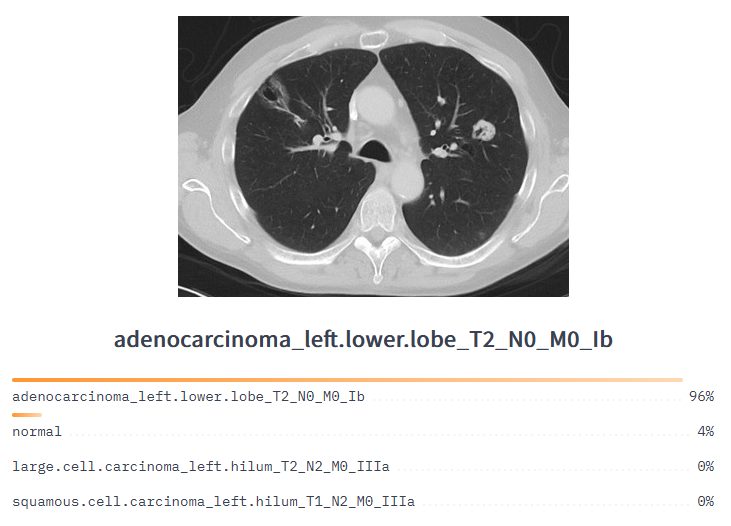 Lung cancer classification model