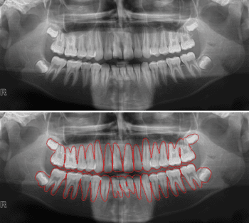 Medical Imaging Application for Instance Segmentation