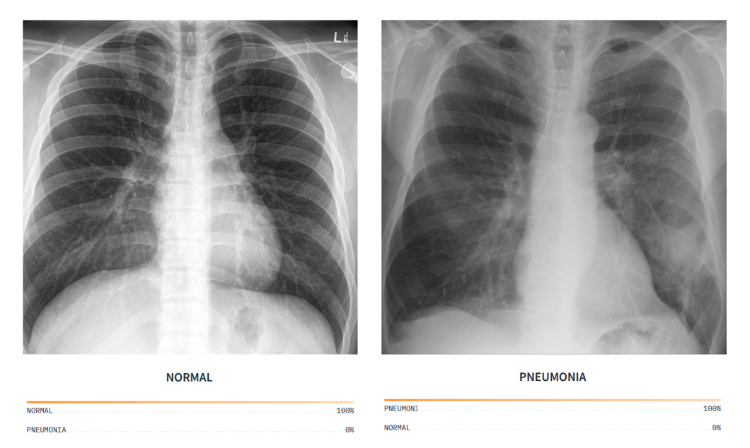 A computer vision model for pneumonia classification in medical imaging