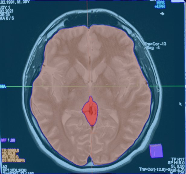Medical scan segmentation applied to a brain MRI 
