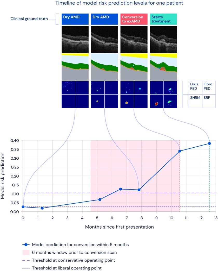 Graphical representation of a patient's risk prediction for Age-related Macular Degeneration (AMD) progression over time, from dry AMD to exudative AMD (exAMD), with corresponding OCT images.