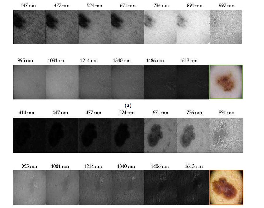 image of skin-cancer-detection-multispectral-imaging