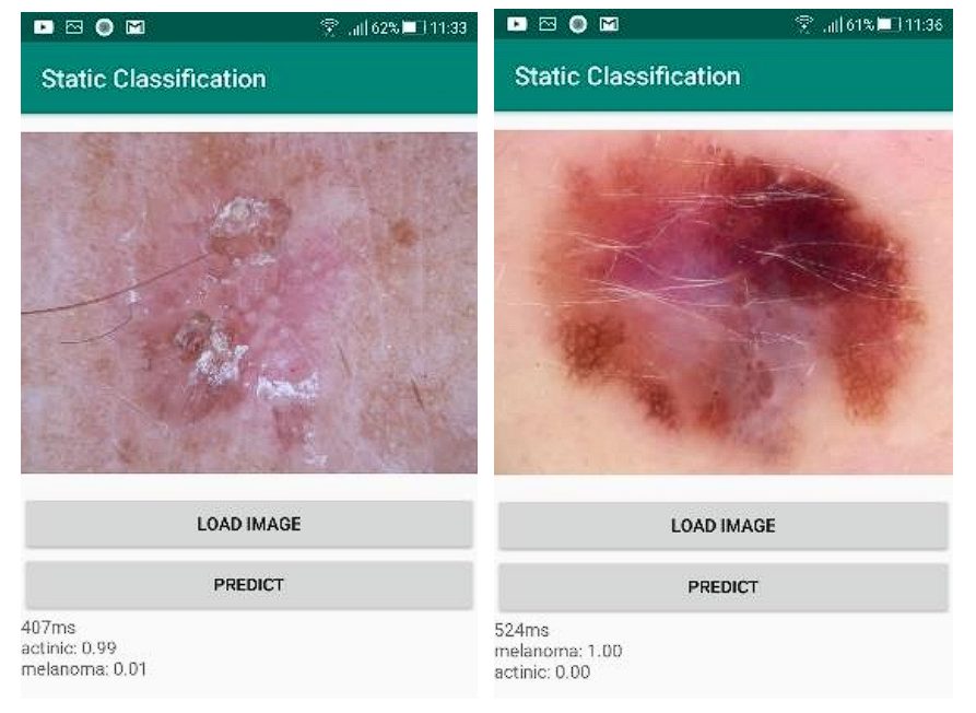 image showing skin cancer detection