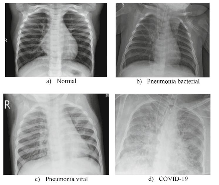 images of xray from different classes of dieases